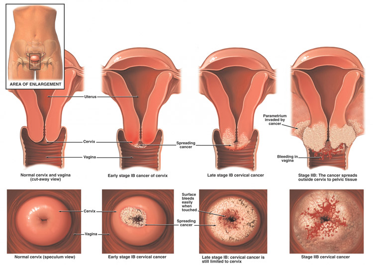 Cervical Cancer
