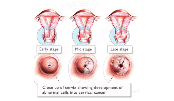 HPV stages
