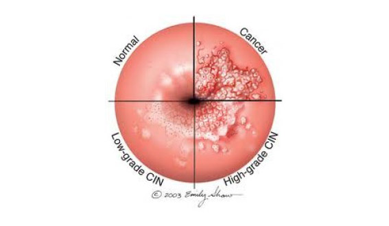 cancer hpv